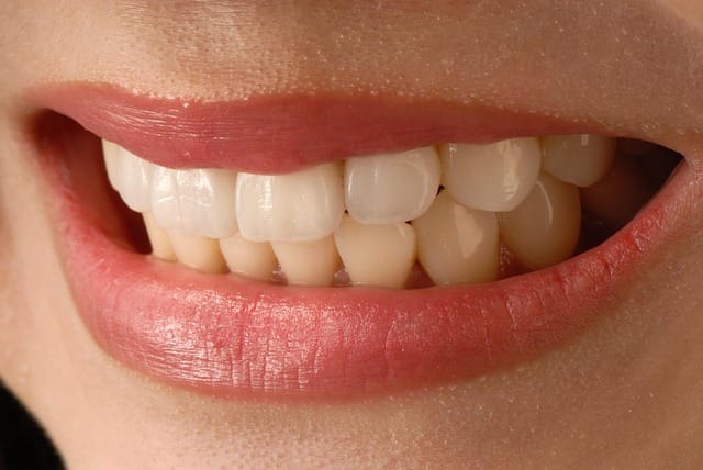 dental veneers